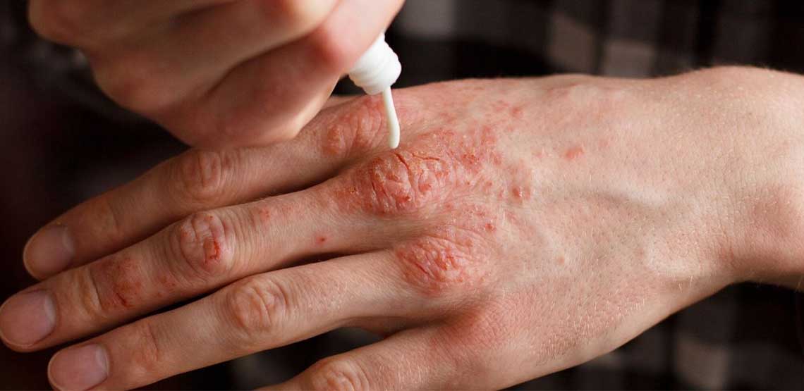 A person applying lotion to psoriasis on their hands.
