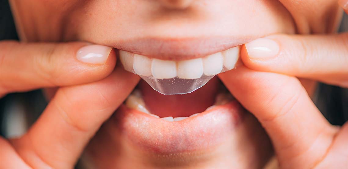 A person putting a teeth whitening strip on their upper teeth.