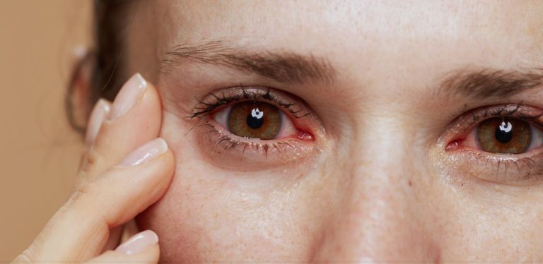 signs of dry eye - itchy eyes